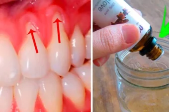10 Easy Ways to Heal Receding Gums Naturally