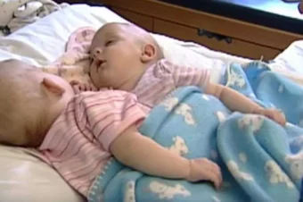 10 Years Ago These Conjoined Twins Were Separated. What Do They Look Like Now?