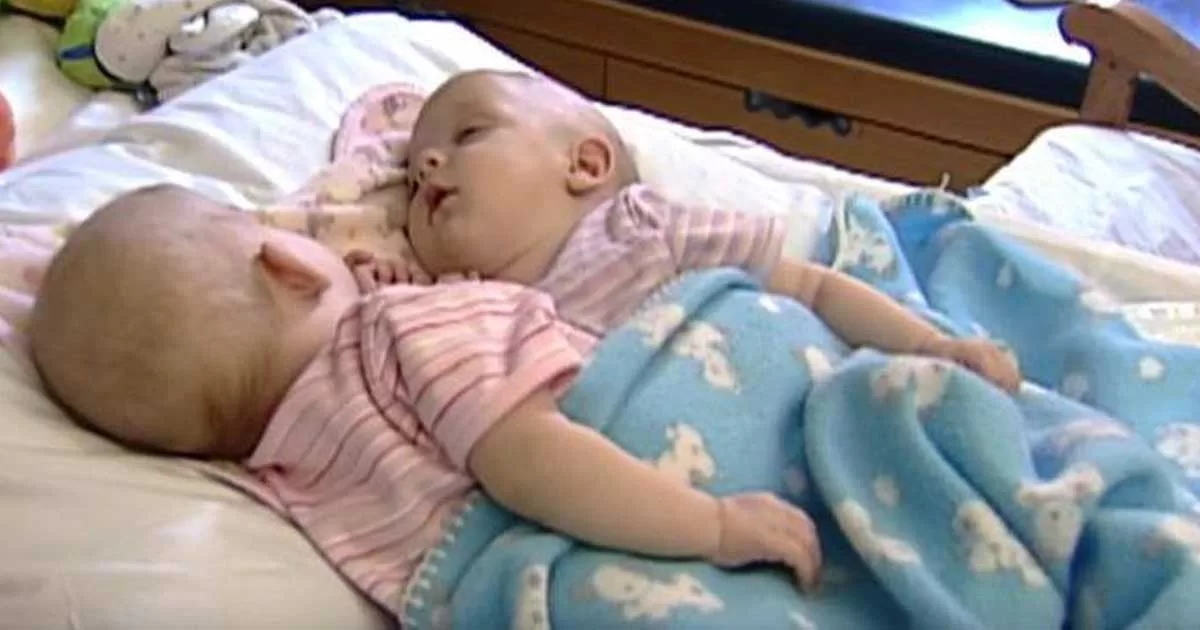 10 Years Ago These Conjoined Twins Were Separated. What Do They Look Like Now?