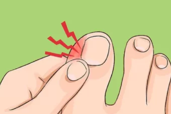 4 Remedies To Treat Ingrown Toe Nails At Home
