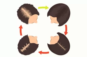 5 Unusual Things That Are Causing Hair Loss and What to Do About It