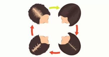 5 Unusual Things That Are Causing Hair Loss and What to Do About It