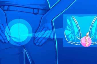 7 Ways To Naturally Treat Hemorrhoids With Coconut Oil