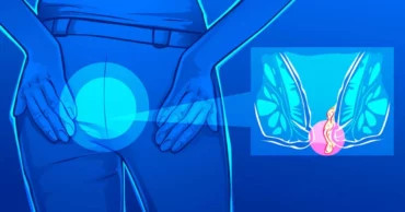 7 Ways To Naturally Treat Hemorrhoids With Coconut Oil