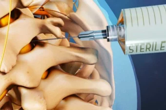 FDA Warns About Dangers of Epidural Steroid Injections for Back Pain