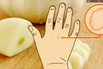 How to remove moles, warts, blackheads, skin tags, and age spots completely naturally