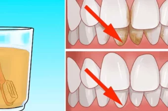 How To Remove Tartar From Teeth By Yourself