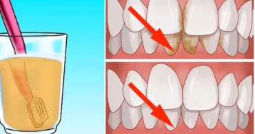 How To Remove Tartar From Teeth By Yourself