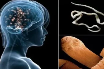 If You Are Eating This Common Food You Have BIG Chance To Get Brain Worms