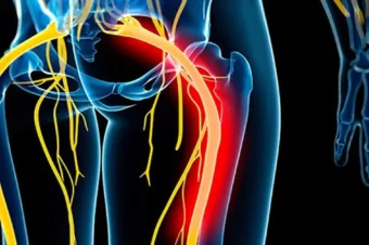 Press These Points: 18 Self-Help Tips For Sciatica That Truly Work