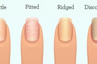 This Is What Your Fingernails Are Warning You About: Organ Failure, Inflammation, or Worse