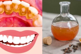 This Mouthwash Removes Plaque From Teeth In 2 Minutes